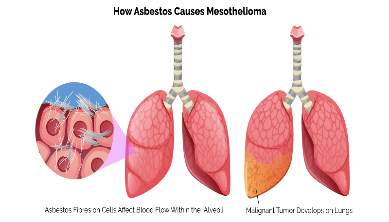 Diagram Showing How Asbestos Causes Mesothelioma
